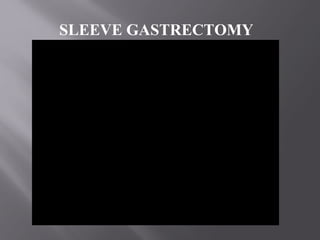 SLEEVE GASTRECTOMY
 
