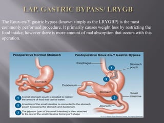 The Roux-en-Y gastric bypass (known simply as the LRYGBP) is the most
commonly performed procedure. It primarily causes weight loss by restricting the
food intake, however there is more amount of mal absorption that occurs with this
operation.
 