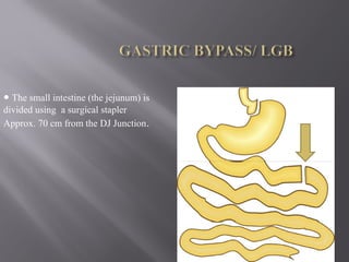 • The small intestine (the jejunum) is
divided using a surgical stapler
Approx. 70 cm from the DJ Junction.
 