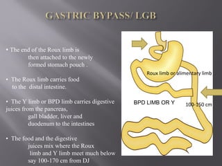 Y- LIMB/ BP
LIMB
• The end of the Roux limb is
then attached to the newly
formed stomach pouch .
• The Roux limb carries food
to the distal intestine.
• The Y limb or BPD limb carries digestive
juices from the pancreas,
gall bladder, liver and
duodenum to the intestines
• The food and the digestive
juices mix where the Roux
limb and Y limb meet much below
say 100-170 cm from DJ
Roux limb or alimentary limb
100-150 cmBPD LIMB OR Y
 