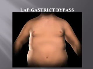 LAP GASTRICT BYPASS
 