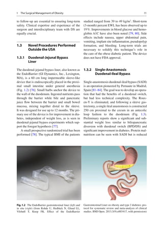 Bariatric surgery complications | PDF