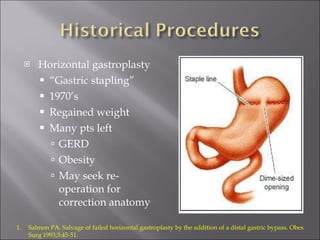 Horizontal gastroplasty “ Gastric stapling” 1970’s Regained weight Many pts left GERD Obesity May seek re-operation for correction anatomy Salmon PA. Salvage of failed horizontal gastroplasty by the addition of a distal gastric bypass. Obes Surg 1993;3:45-51. 
