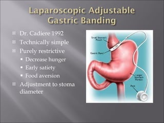 Dr. Cadiere 1992 Technically simple Purely restrictive Decrease hunger Early satiety Food aversion Adjustment to stoma diameter 