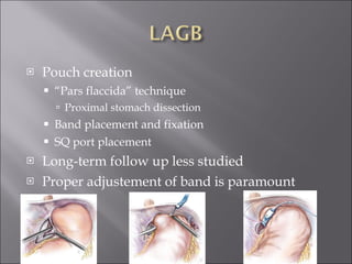 Pouch creation “ Pars flaccida” technique Proximal stomach dissection Band placement and fixation SQ port placement Long-term follow up less studied Proper adjustement of band is paramount 