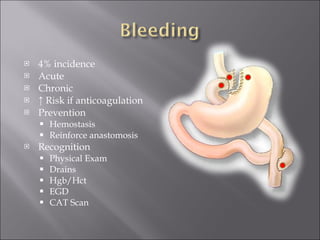 4% incidence Acute Chronic ↑  Risk if anticoagulation Prevention Hemostasis Reinforce anastomosis Recognition Physical Exam Drains Hgb/Hct EGD CAT Scan 