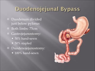 Duodenum divided just below pylorus Both limbs: 75cm Gastrojejunostomy: 50% hand-sewn 50% stapled Duodenojejunostomy: 100% hand-sewn 