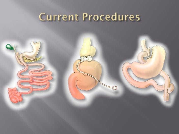 Bariatric Surgery Options, Trends, and Latest Innovations