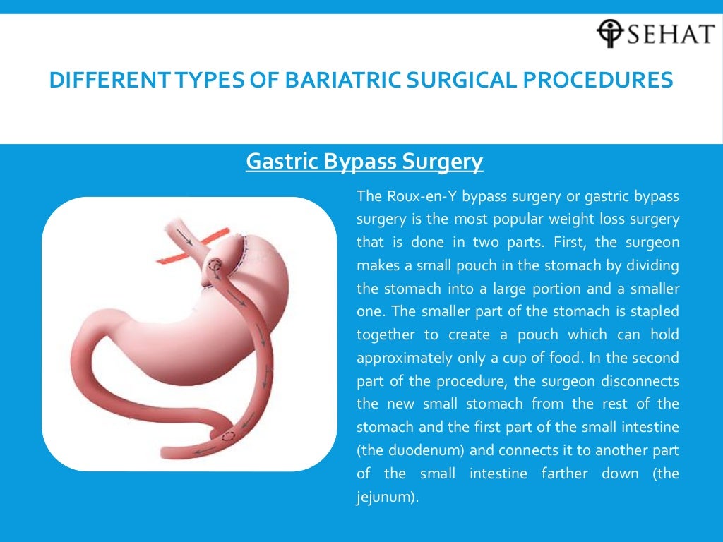 Bariatric surgery procedure