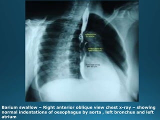 Barium swallow – Right anterior oblique view chest x-ray – showing
normal indentations of oesophagus by aorta , left bronchus and left
atrium
 