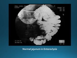 Normal jejunum in Enteroclysis
 