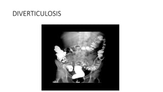 DIVERTICULOSIS
 