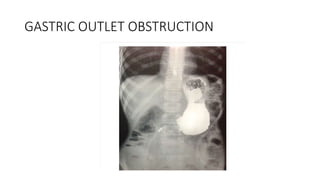 GASTRIC OUTLET OBSTRUCTION
 