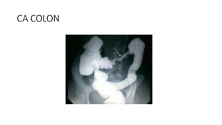 CA COLON
 