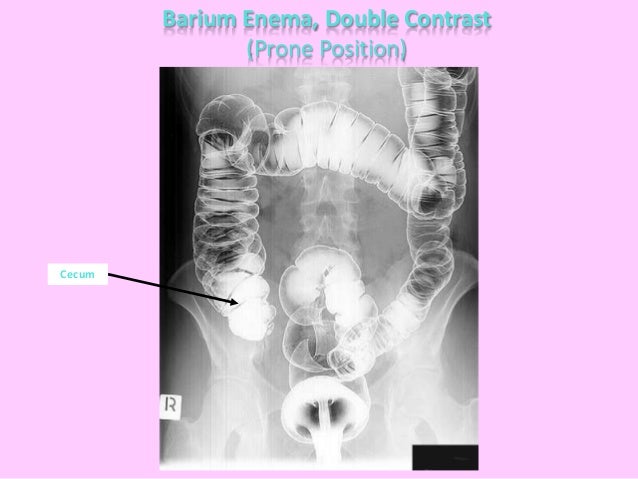 Double Contrast Barium Enema Preparation Diet clipinter