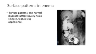 Surface patterns in enema
• Surface patterns The normal
mucosal surface usually has a
smooth, featureless
appearance.
 