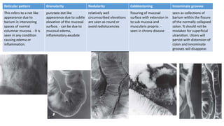 Reticular pattern Granularity Nodularity Cobblestoning Innominate grooves
This refers to a net like
appearance due to
barium in intervening
spaces of normal
columnar mucosa. - It is
seen in any condition
causing edema or
inflammation.
punctate dot like
appearance due to subtle
elevation of the mucosal
surface. - can be due to
mucosal edema,
inflammatory exudate
relatively well
circumscribed elevations
are seen as round or
ovoid radiolucencies
fissuring of mucosal
surface with extension in
to sub mucosa and
muscularis propria. -
seen in chrons disease
seen as collections of
barium within the fissure
of the normally collapsed
colon. It should not be
mistaken for superficial
ulceration. Ulcers will
persist with distension of
colon and innominate
grooves will disappear.
 