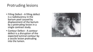 Protruding lesions
• Filling Defect - A filling defect
is a radiolucency in the
barium pool caused by
displacement of the barium
by a protruding lesion in a
single contrast study.
• Contour Defect - A contour
defect is a disruption of the
expected luminal contour by
a sessile lesion protruding
into the lumen.
 