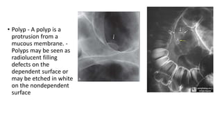 • Polyp - A polyp is a
protrusion from a
mucous membrane. -
Polyps may be seen as
radiolucent filling
defects on the
dependent surface or
may be etched in white
on the nondependent
surface
 