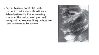 • Carpet Lesion - focal, flat, well-
circumscribed surface elevations. -
When barium fills the intervening
spaces of the lesion, multiple small,
polygonal radiolucent filling defects are
seen surrounded by barium.
 