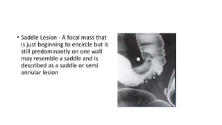• Saddle Lesion - A focal mass that
is just beginning to encircle but is
still predominantly on one wall
may resemble a saddle and is
described as a saddle or semi
annular lesion
 