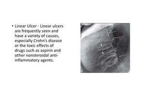 • Linear Ulcer - Linear ulcers
are frequently seen and
have a variety of causes,
especially Crohn’s disease
or the toxic effects of
drugs such as aspirin and
other nonsteroidal anti-
inflammatory agents.
 