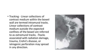 • Tracking - Linear collections of
contrast medium within the bowel
wall are termed intramural tracks.
Linear collections of contrast
medium outside the expected
confines of the bowel are referred
to as extramural tracks. -Tracks
associated with radiation damage,
trauma, Crohn’s disease, or
iatrogenic perforation may spread
in any direction.
 