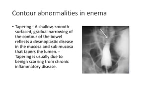 Contour abnormalities in enema
• Tapering - A shallow, smooth-
surfaced, gradual narrowing of
the contour of the bowel
reflects a desmoplastic disease
in the mucosa and sub mucosa
that tapers the lumen. -
Tapering is usually due to
benign scarring from chronic
inflammatory disease.
 