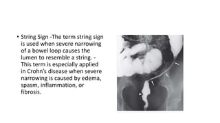 • String Sign -The term string sign
is used when severe narrowing
of a bowel loop causes the
lumen to resemble a string. -
This term is especially applied
in Crohn’s disease when severe
narrowing is caused by edema,
spasm, inflammation, or
fibrosis.
 