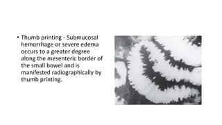 • Thumb printing - Submucosal
hemorrhage or severe edema
occurs to a greater degree
along the mesenteric border of
the small bowel and is
manifested radiographically by
thumb printing.
 