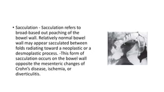 • Sacculation - Sacculation refers to
broad-based out poaching of the
bowel wall. Relatively normal bowel
wall may appear sacculated between
folds radiating toward a neoplastic or a
desmoplastic process. -This form of
sacculation occurs on the bowel wall
opposite the mesenteric changes of
Crohn’s disease, ischemia, or
diverticulitis.
 