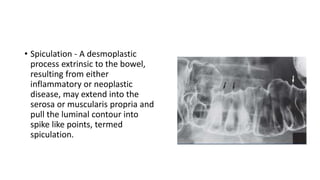 • Spiculation - A desmoplastic
process extrinsic to the bowel,
resulting from either
inflammatory or neoplastic
disease, may extend into the
serosa or muscularis propria and
pull the luminal contour into
spike like points, termed
spiculation.
 