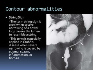 Barium enema procedure and patterns | PPTX