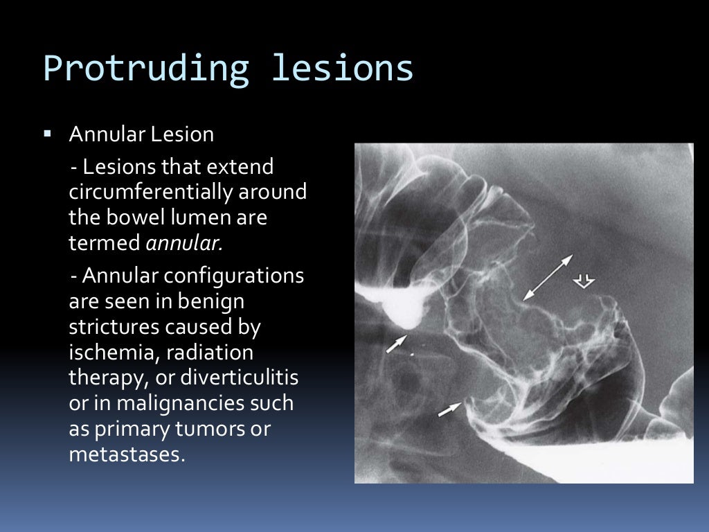 Barium enema procedure and patterns