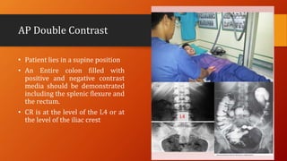 AP Double Contrast
• Patient lies in a supine position
• An Entire colon filled with
positive and negative contrast
media should be demonstrated
including the splenic flexure and
the rectum.
• CR is at the level of the L4 or at
the level of the iliac crest
 
