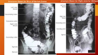 structure Shown for Right Anterior ObliqueStructures Shown for PA or AP Barium Enema
 