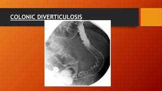 COLONIC DIVERTICULOSIS
 