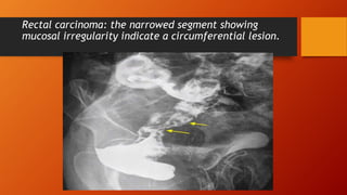 Rectal carcinoma: the narrowed segment showing
mucosal irregularity indicate a circumferential lesion.
 