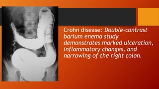 Crohn disease: Double-contrast
barium enema study
demonstrates marked ulceration,
inflammatory changes, and
narrowing of the right colon.
 