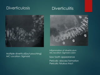Pericholic bariumenema study seminar topic presentation | PPTX
