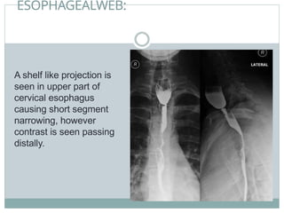 ESOPHAGEALWEB:
A shelf like projection is
seen in upper part of
cervical esophagus
causing short segment
narrowing, however
contrast is seen passing
distally.
 