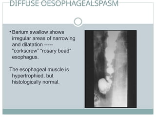 DIFFUSE OESOPHAGEALSPASM
• Barium swallow shows
irregular areas of narrowing
and dilatation -----
“corkscrew” “rosary bead"
esophagus.
The esophageal muscle is
hypertrophied, but
histologically normal.
 