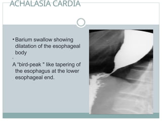 ACHALASIA CARDIA
• Barium swallow showing
dilatation of the esophageal
body
•
A “bird-peak " like tapering of
the esophagus at the lower
esophageal end.
 