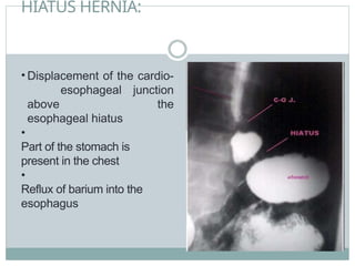 HIATUS HERNIA:
• Displacement of the cardio-
esophageal junction
above the
esophageal hiatus
•
Part of the stomach is
present in the chest
•
Reflux of barium into the
esophagus
 