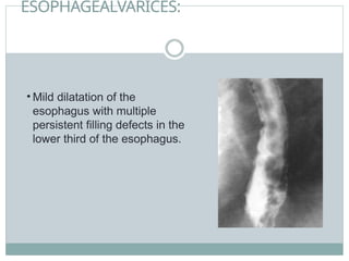 ESOPHAGEALVARICES:
• Mild dilatation of the
esophagus with multiple
persistent filling defects in the
lower third of the esophagus.
 