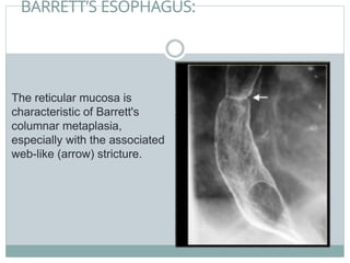 BARRETT’S ESOPHAGUS:
The reticular mucosa is
characteristic of Barrett's
columnar metaplasia,
especially with the associated
web-like (arrow) stricture.
 