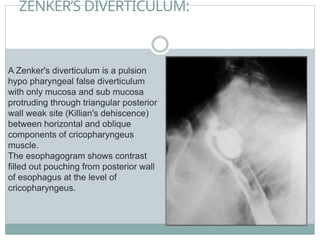 ZENKER’S DIVERTICULUM:
A Zenker's diverticulum is a pulsion
hypo pharyngeal false diverticulum
with only mucosa and sub mucosa
protruding through triangular posterior
wall weak site (Killian's dehiscence)
between horizontal and oblique
components of cricopharyngeus
muscle.
The esophagogram shows contrast
filled out pouching from posterior wall
of esophagus at the level of
cricopharyngeus.
 