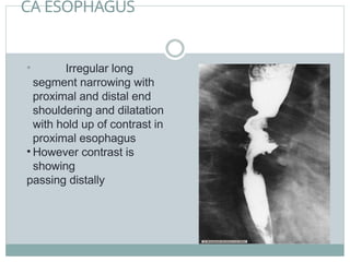 CA ESOPHAGUS
• Irregular long
segment narrowing with
proximal and distal end
shouldering and dilatation
with hold up of contrast in
proximal esophagus
• However contrast is
showing
passing distally
 