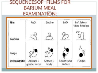 SEQUENCESOF FILMS FOR
BARIUM MEAL
EXAMINATION:
 