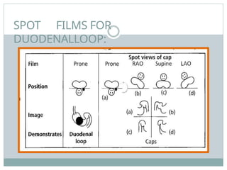 SPOT FILMS FOR
DUODENALLOOP:
 